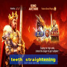 teeth straightening los altos